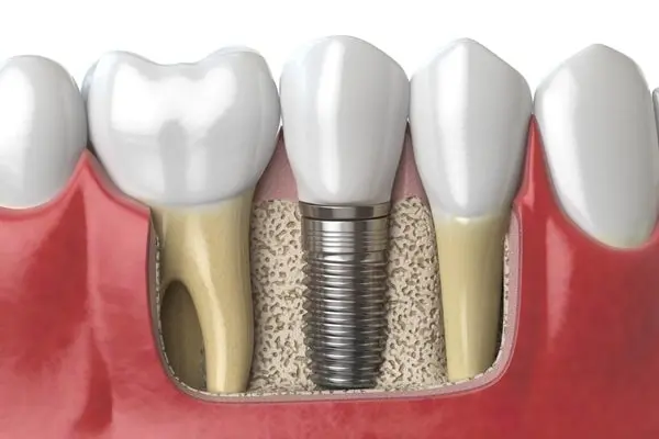 Dental-Implants-Main-1