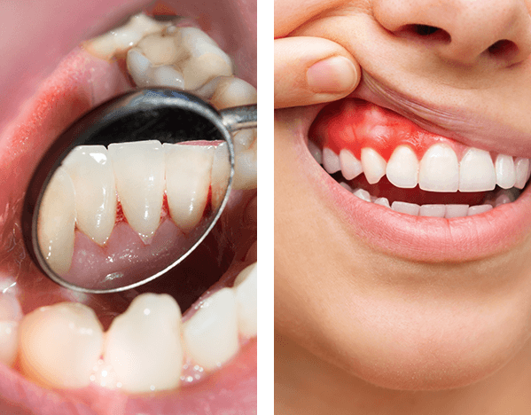 Gum-Problems-Reddish-Gum-Bleeding-Gum-1