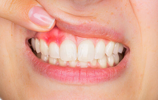 GumTreatment