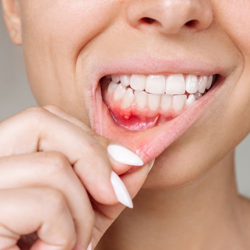Dental-Mouth-Ulcer treatment