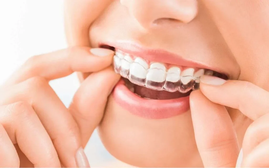 are-clear-aligners-as-effective-as-traditional-braces
