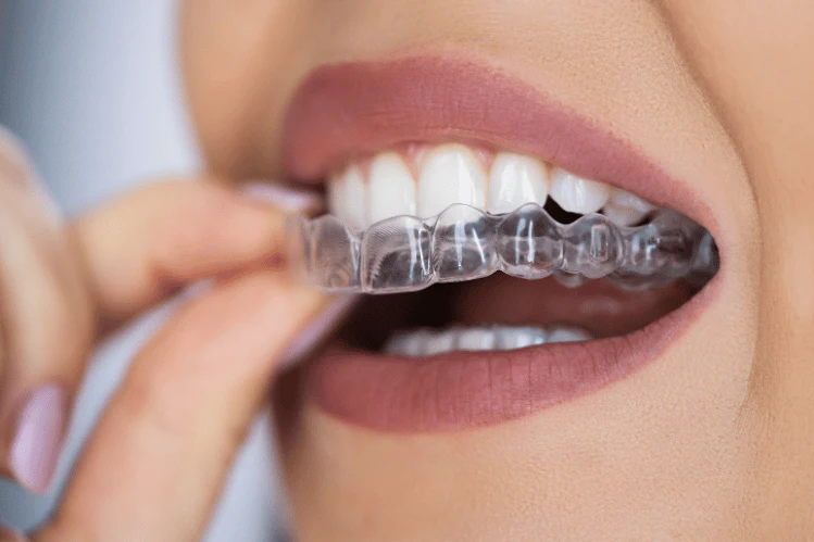 clear-aligner-dental-night-guard_2