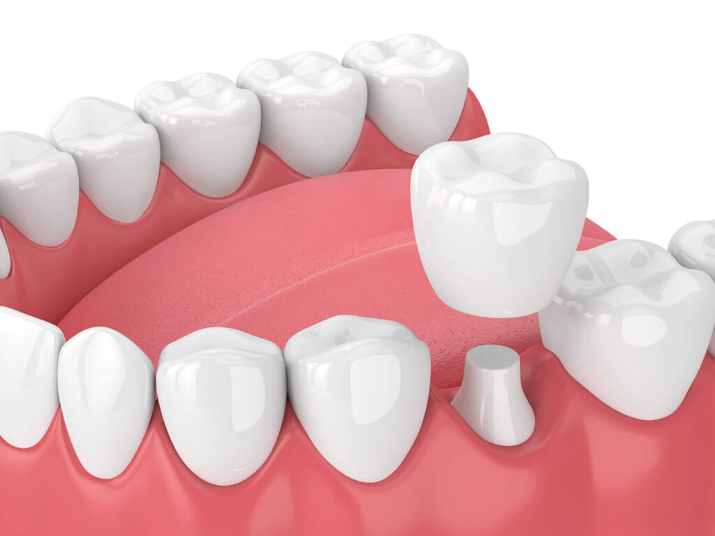 dental-crown-bridge-dental-service-1