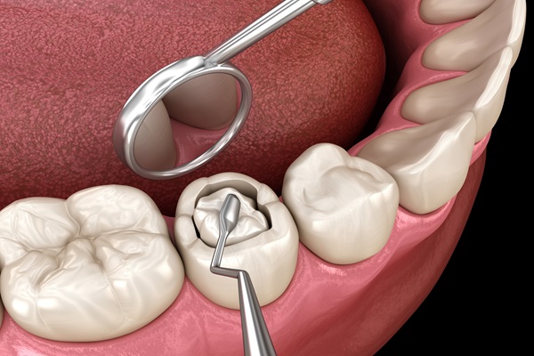 Decayed,Tooth,Restoration,With,Composite,Filling.,Dental,3d,Illustration