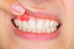 Advanced Gum Treatment at mikael dental