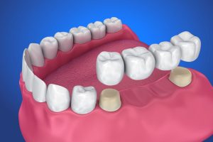 Dental Crowns & Bridges