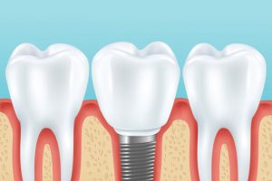 Dental Implant