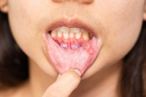 Mouth Ulcers