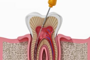 Root Canal Treatment